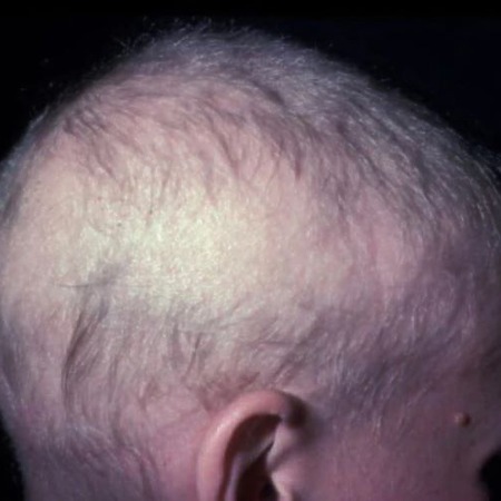 Alopecia totalis