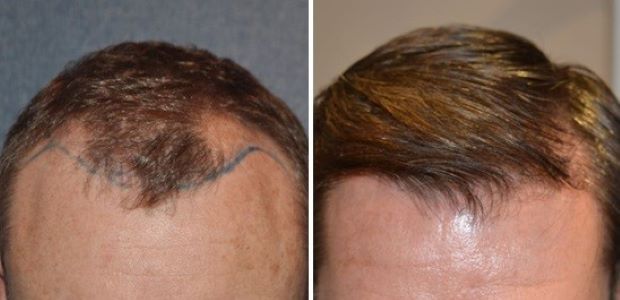 Before and after hair transplant Wimpole Clinic