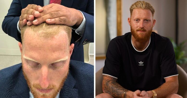 Ben Stokes before and after hair transplant