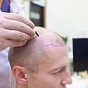 Can I Get A 100% Needle-Free Hair Transplant?