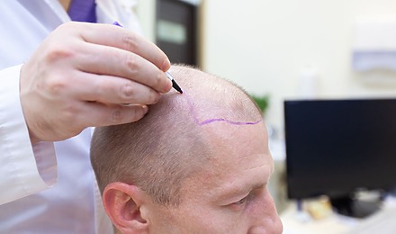 Can I Get A 100% Needle-Free Hair Transplant?