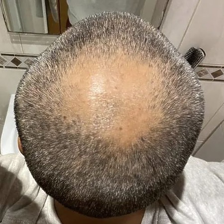 Crown hair loss