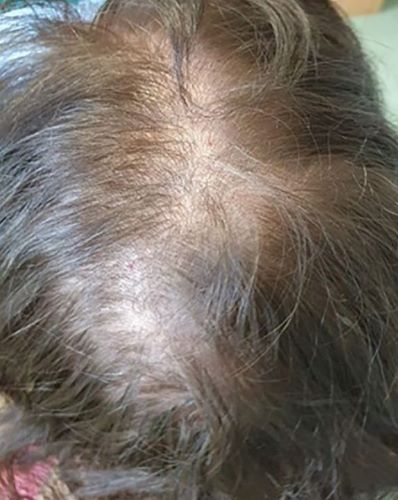 Diffuse thinning