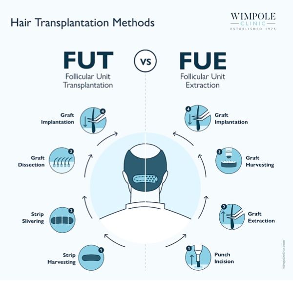 FUE vs FUT beard transplant