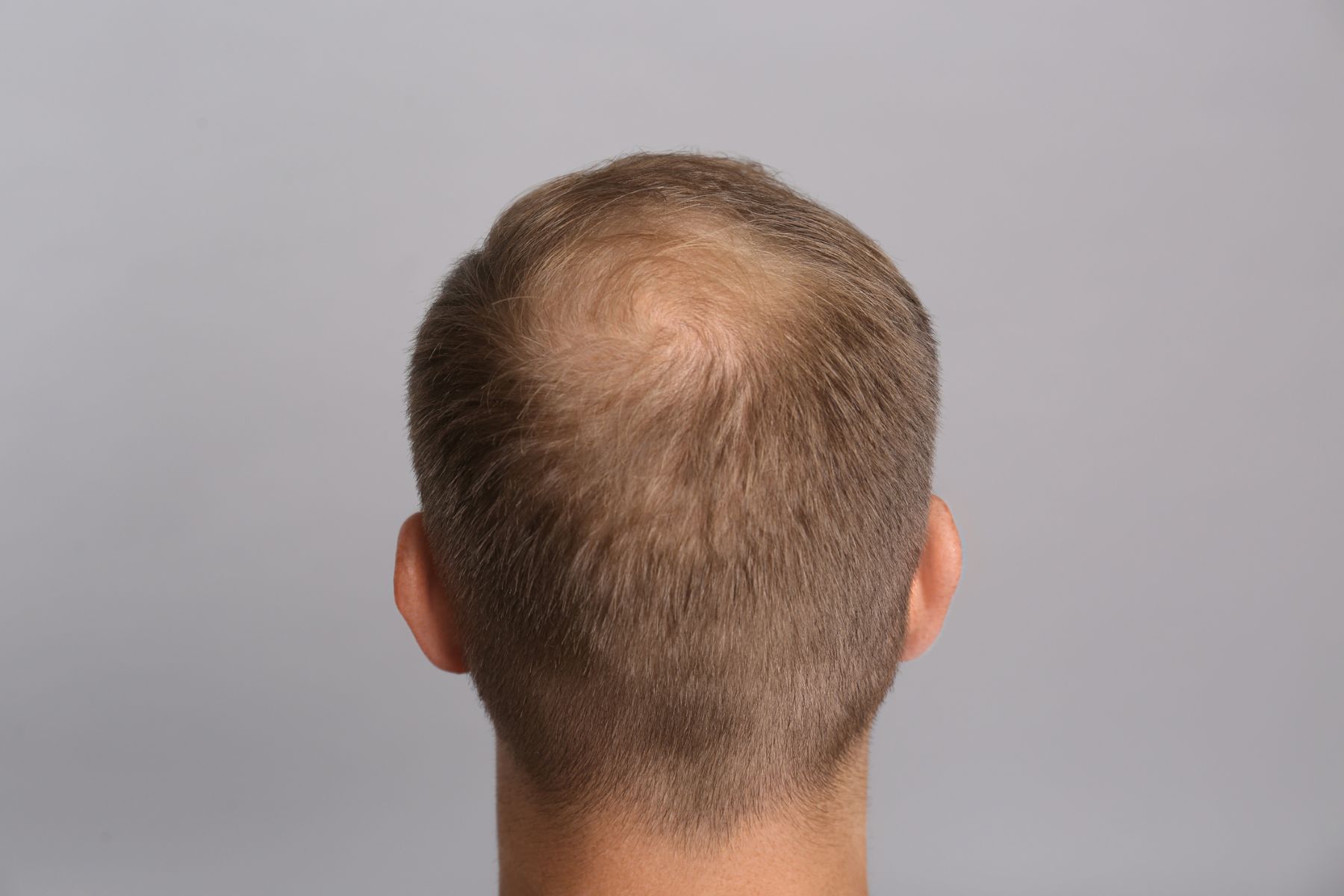 Hair loss from male pattern baldness