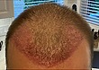 Hair Transplant