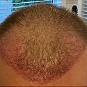 How Long Does Hair Transplant Redness Normally Last?