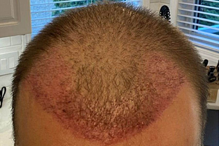 How Long Does Hair Transplant Redness Normally Last?