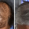 How Long Does A Hair Transplant Last?