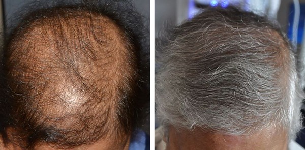 How Long Does a Hair Transplant Last?