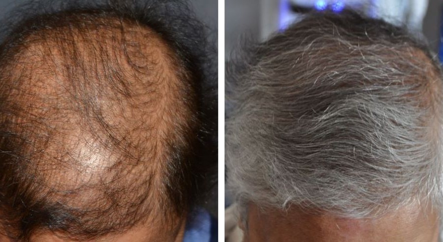 How Long Does A Hair Transplant Last?