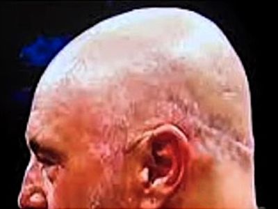 Joe Rogan’s hair transplant scar