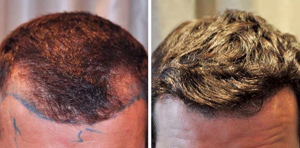 Man before and after a hair transplant