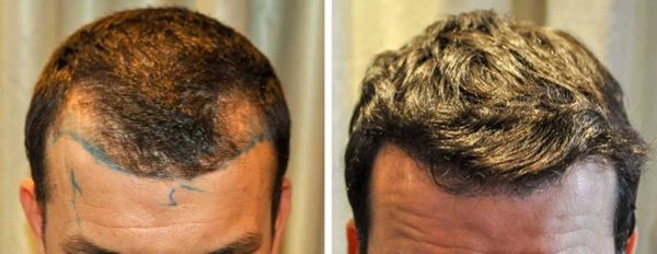 Man before and after his hair transplant