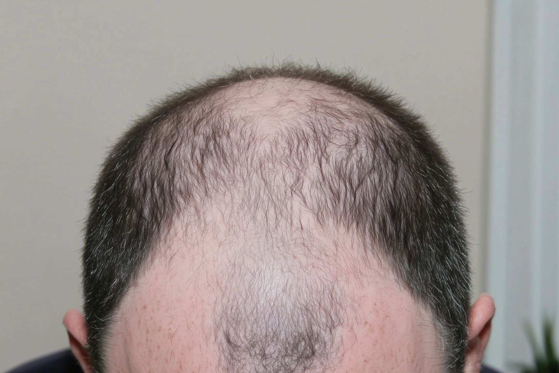 Man experiencing male pattern baldness