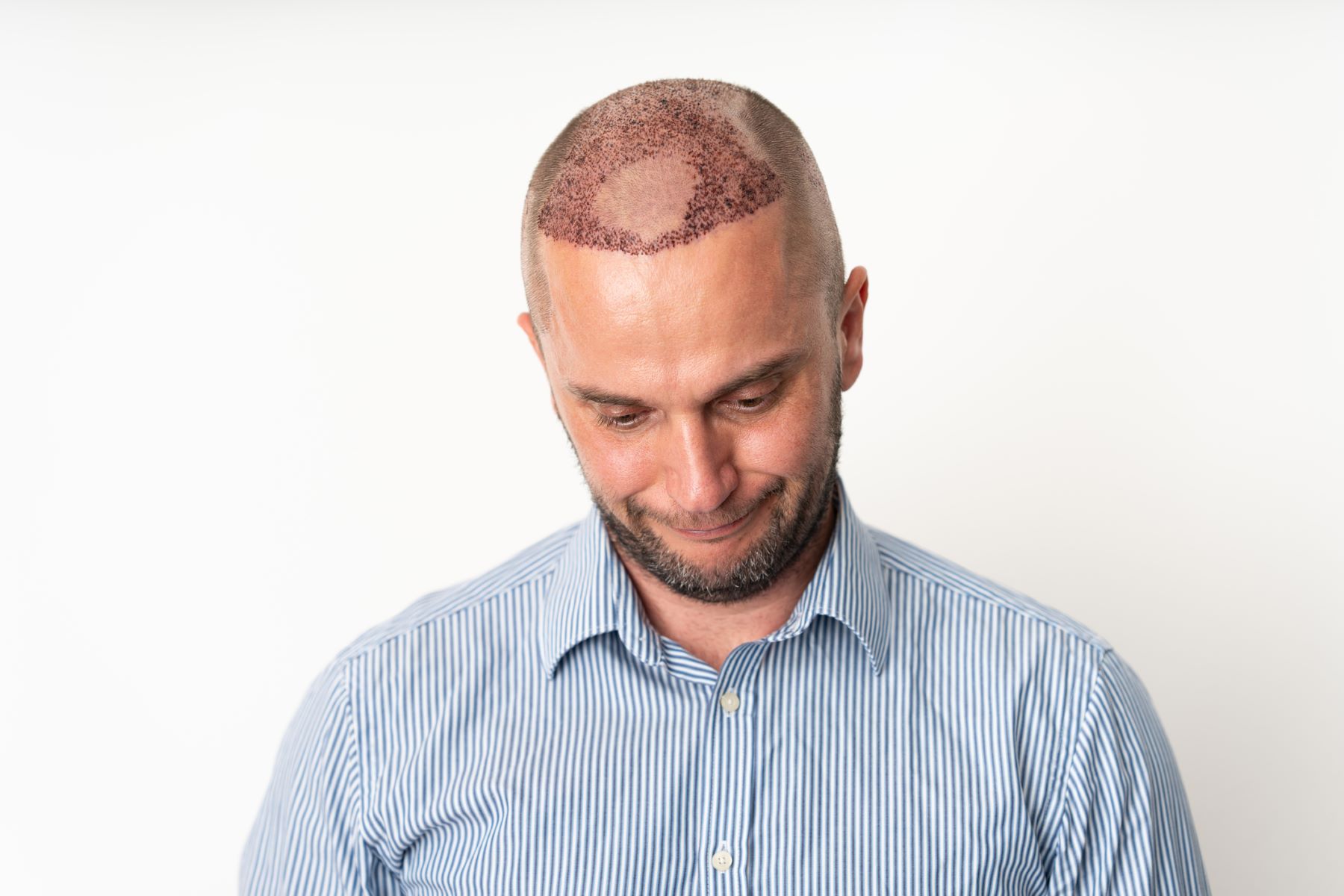 Man experiencing pain after needle-free hair transplant