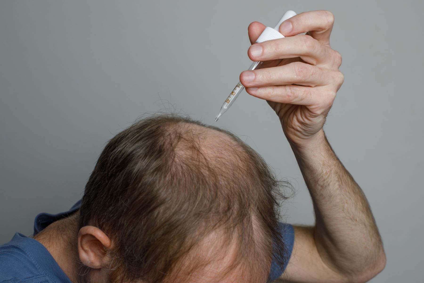 Man using hair loss medications