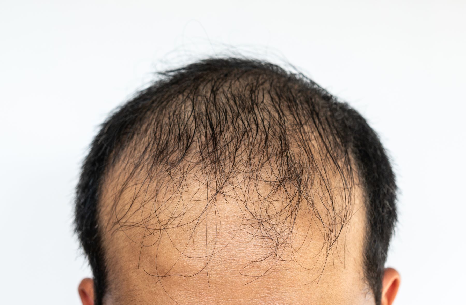 Man with male pattern baldness