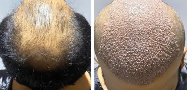 Patient before and after 6000 graft hair transplant