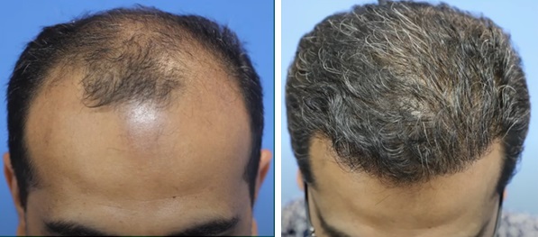 Patient before and after his 6000 graft hair transplant