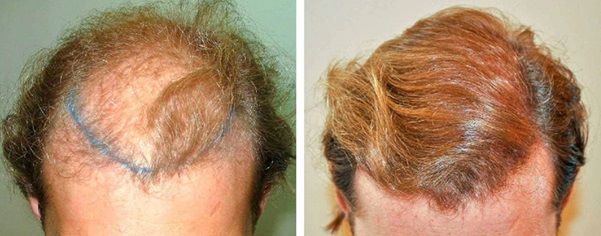 Patient before and after his hair transplant