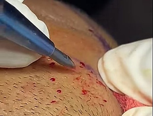 Surgeon making slits on scalp with a blade