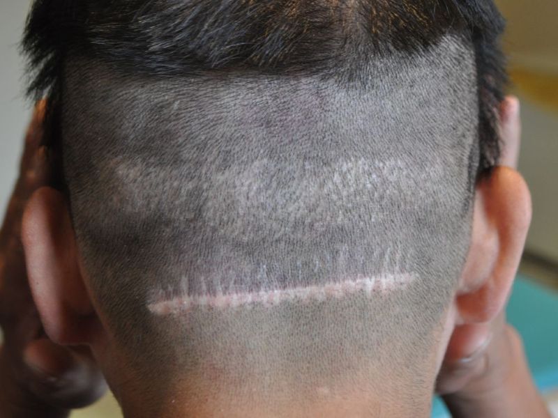 Patient's FUE and FUT hair transplant scars