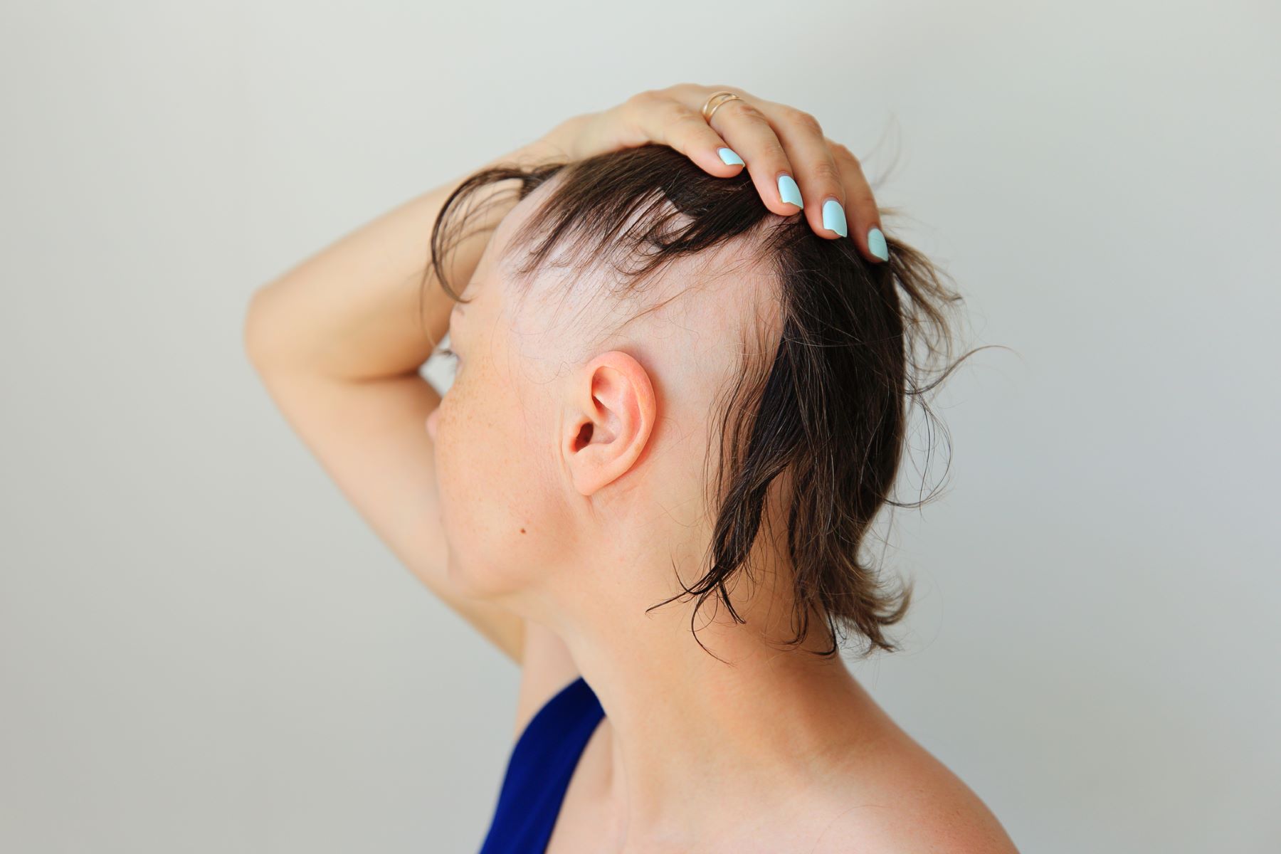 Woman with alopecia areata