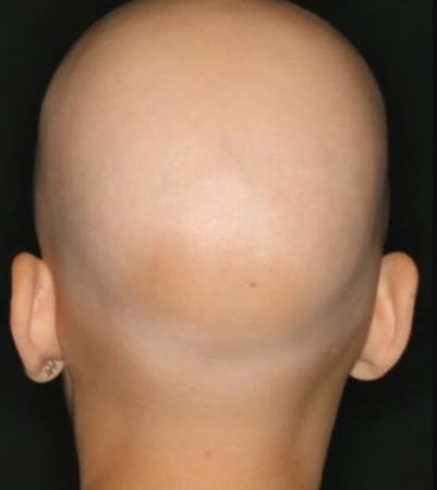 alopecia universalis