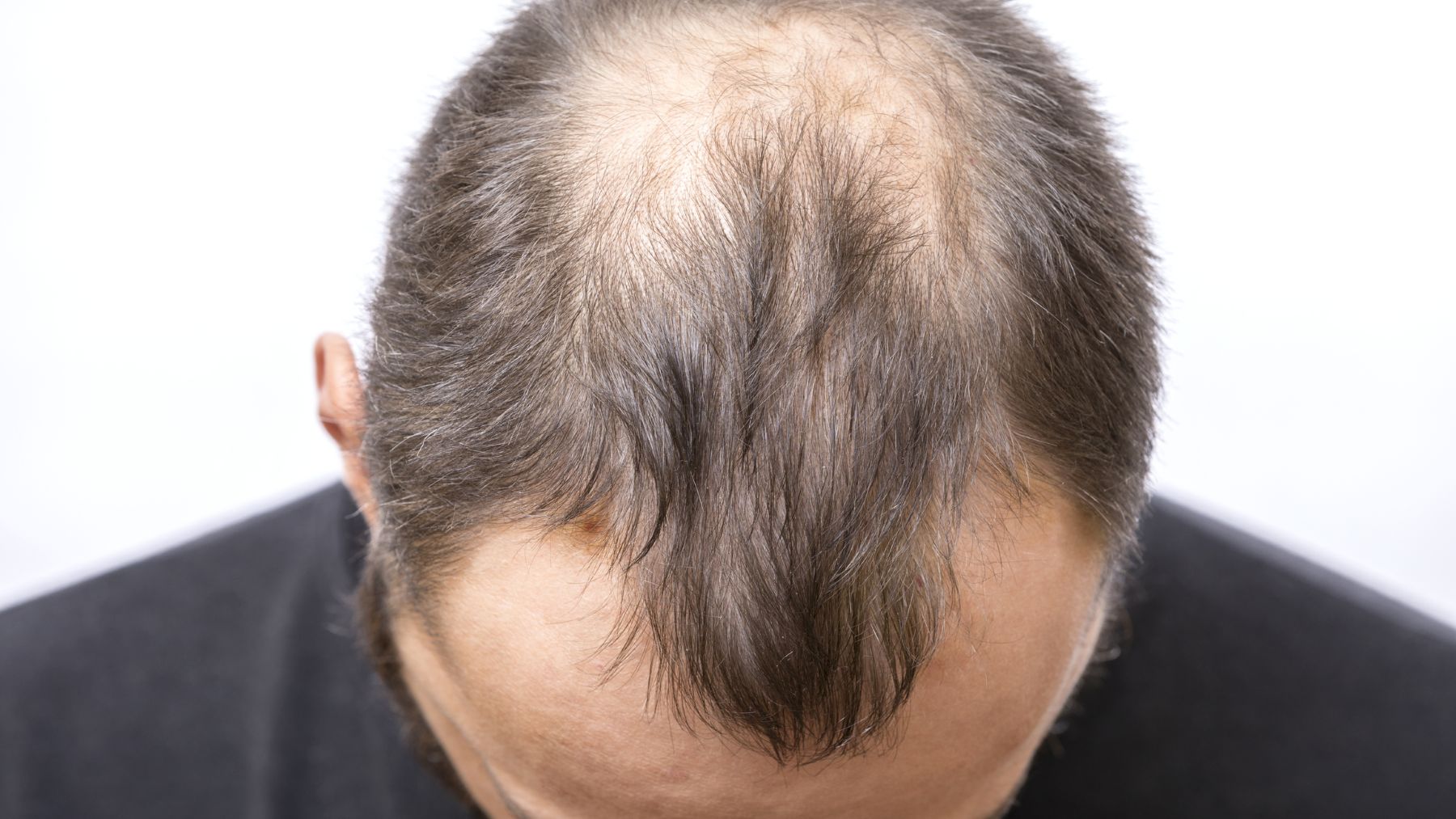 male pattern baldness