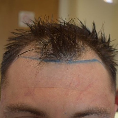 receding hairline