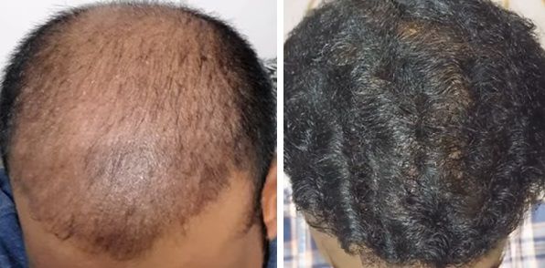 Patient 2 months after and 6 months after his 6000 graft hair transplant