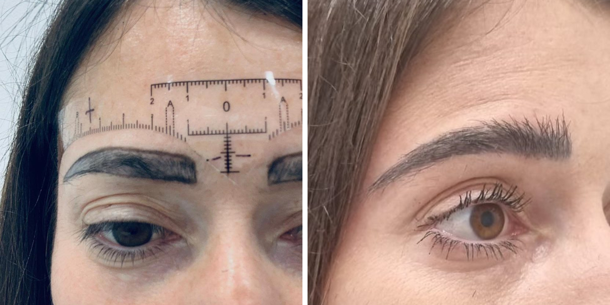 wimpole clinic eyebrow transplant before and after