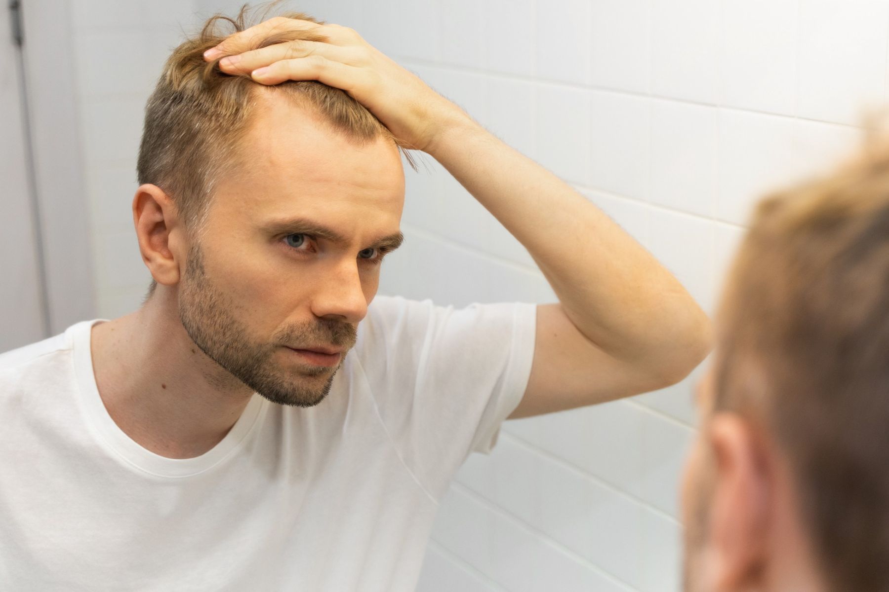 Balding man thinking he may need hair implants