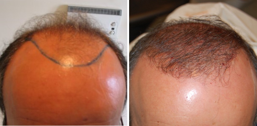 Before and 3 months after a 2200 graft hair transplant