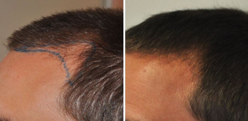 Before and 3 months after an 800 graft hair transplant