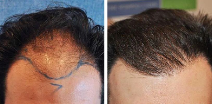 Before and 8 months after 2000-graft hair transplant