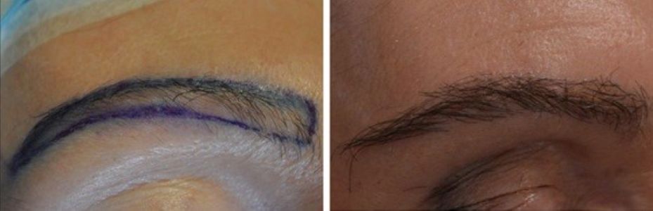 Eyebrow transplant before and after