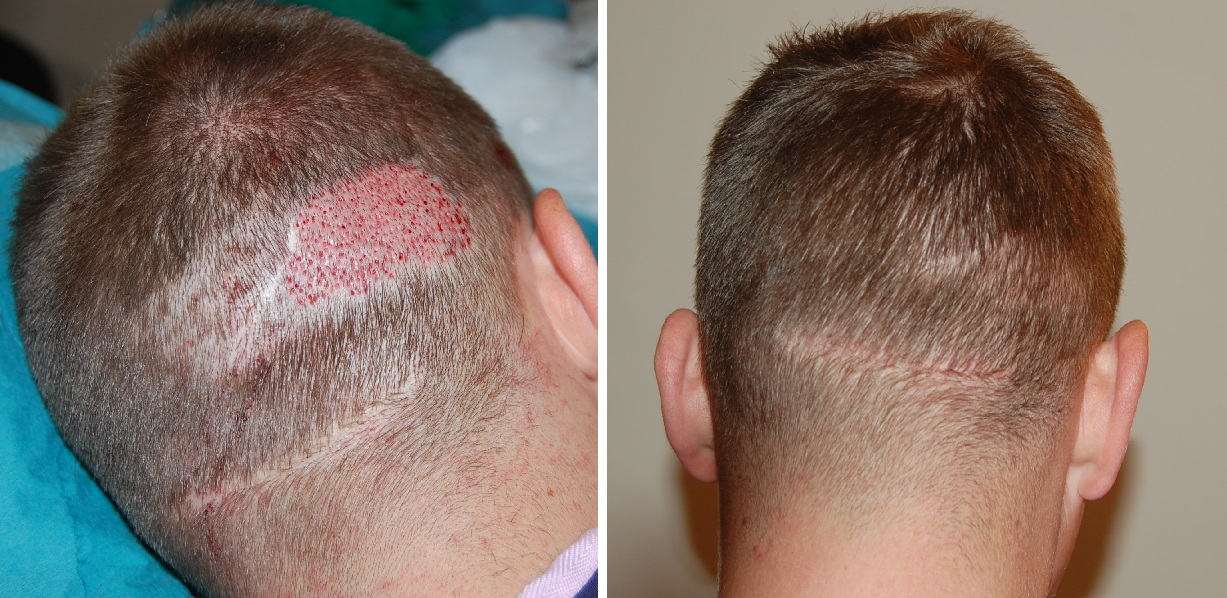 FUE hair transplant 3 months post operation