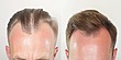 Hair Transplant