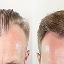 Hair Implants For Men: Procedure, Results, Costs & Recovery