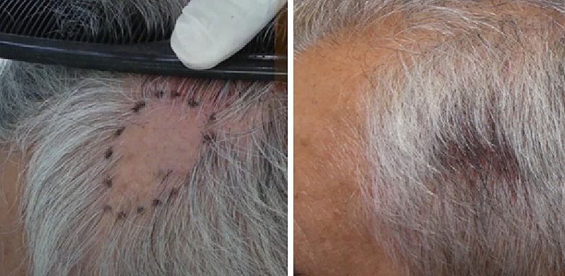 Hair transplant for congenital triangular alopecia