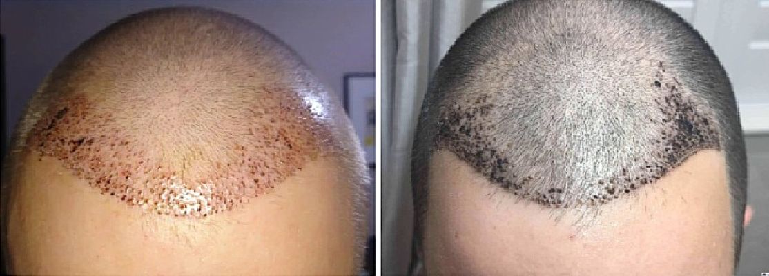 Hair transplant recovery