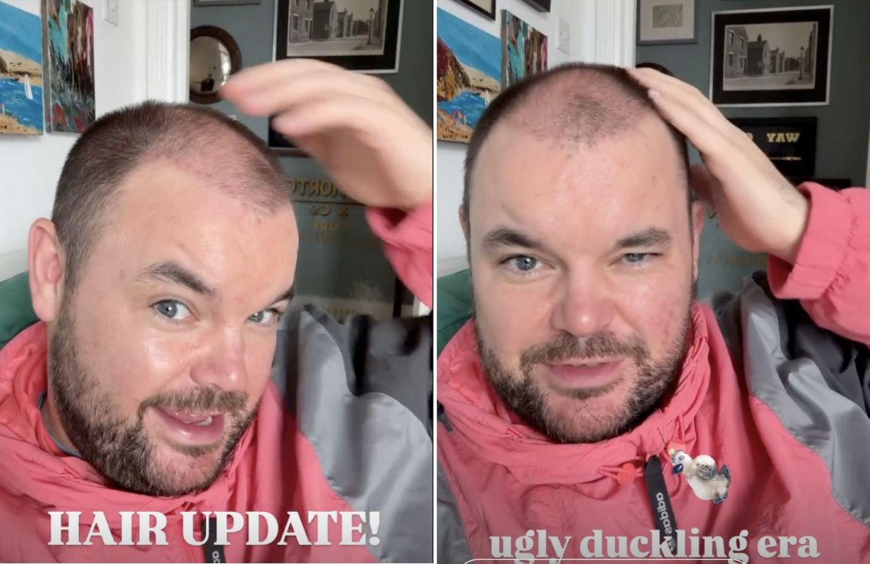 Lloyd Griffith 3 months post hair transplant