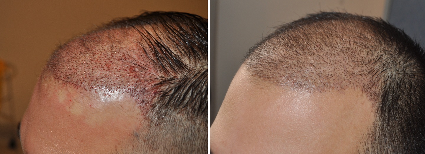 Patient before and 18 days after FUE hair transplant surgery
