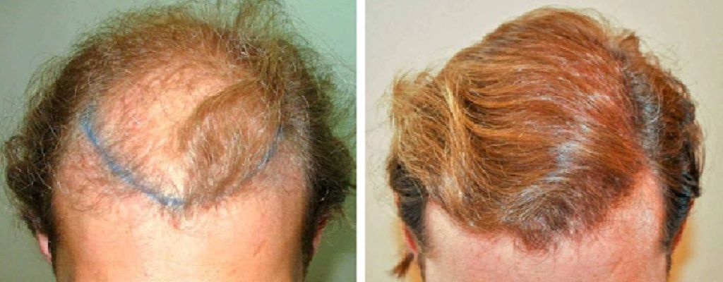 Patient before and 18 months after hair transplant