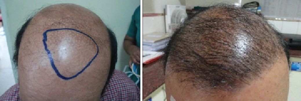 Patient before and after body hair transplant