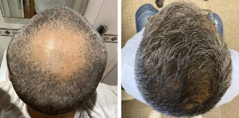 Patient before and after hair transplant