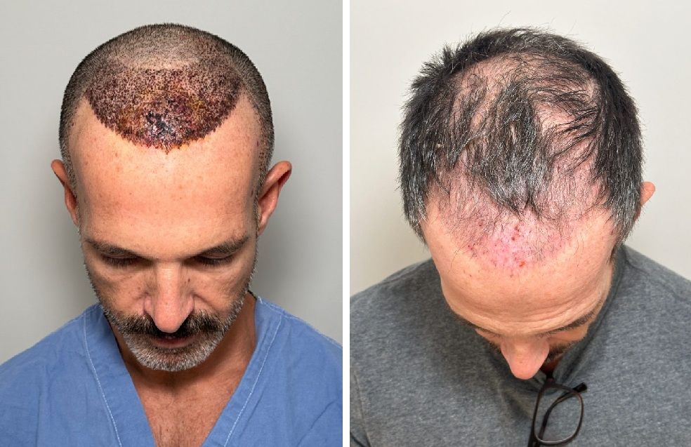 Results of a bad Turkish hair transplant