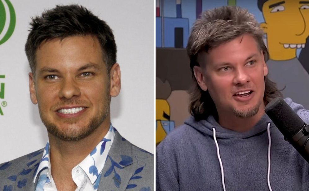 Theo Von hair transplant